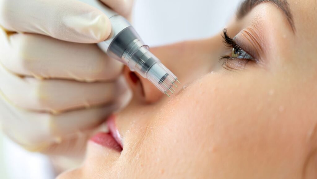Dermapen – mezoterapia mikroigłowa w Impress Warszawa (Mokotów) – efekty, przebieg 1 dermapen efekty